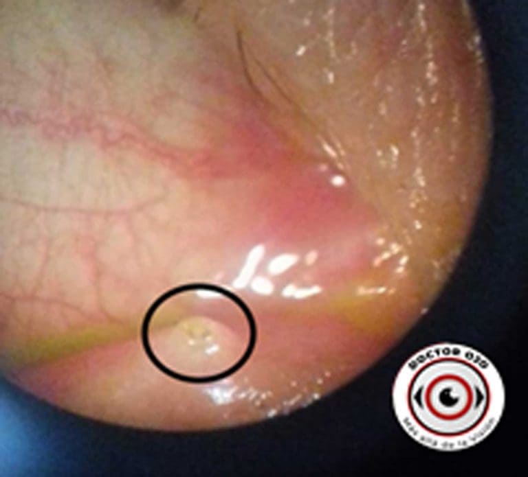 Implante de tapones lagrimales