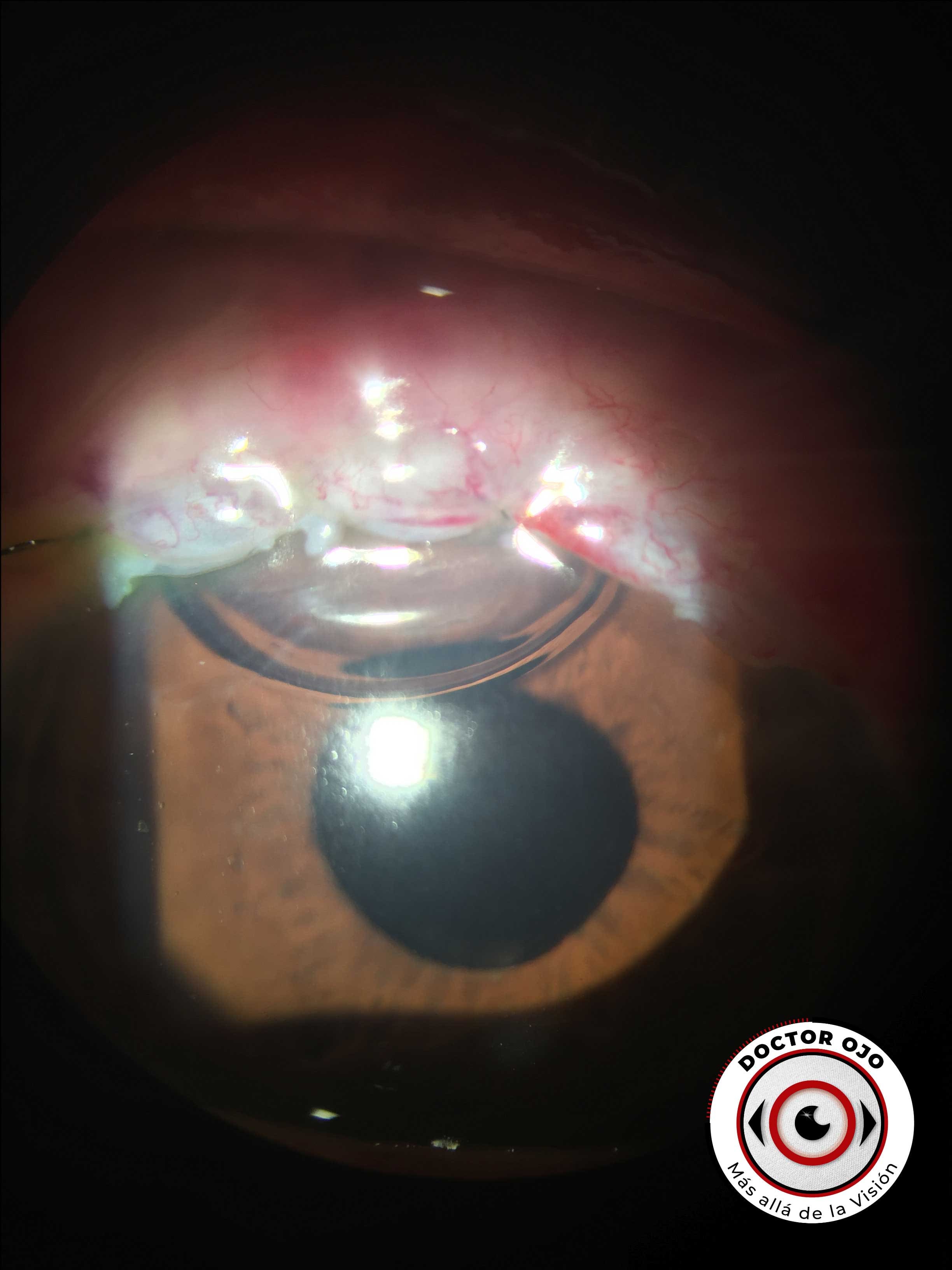 Paciente con trabeculectomía