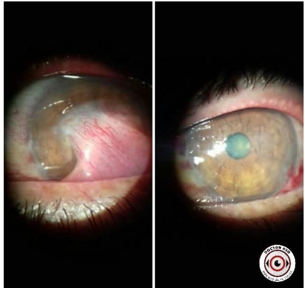  antes y después de la cirugía