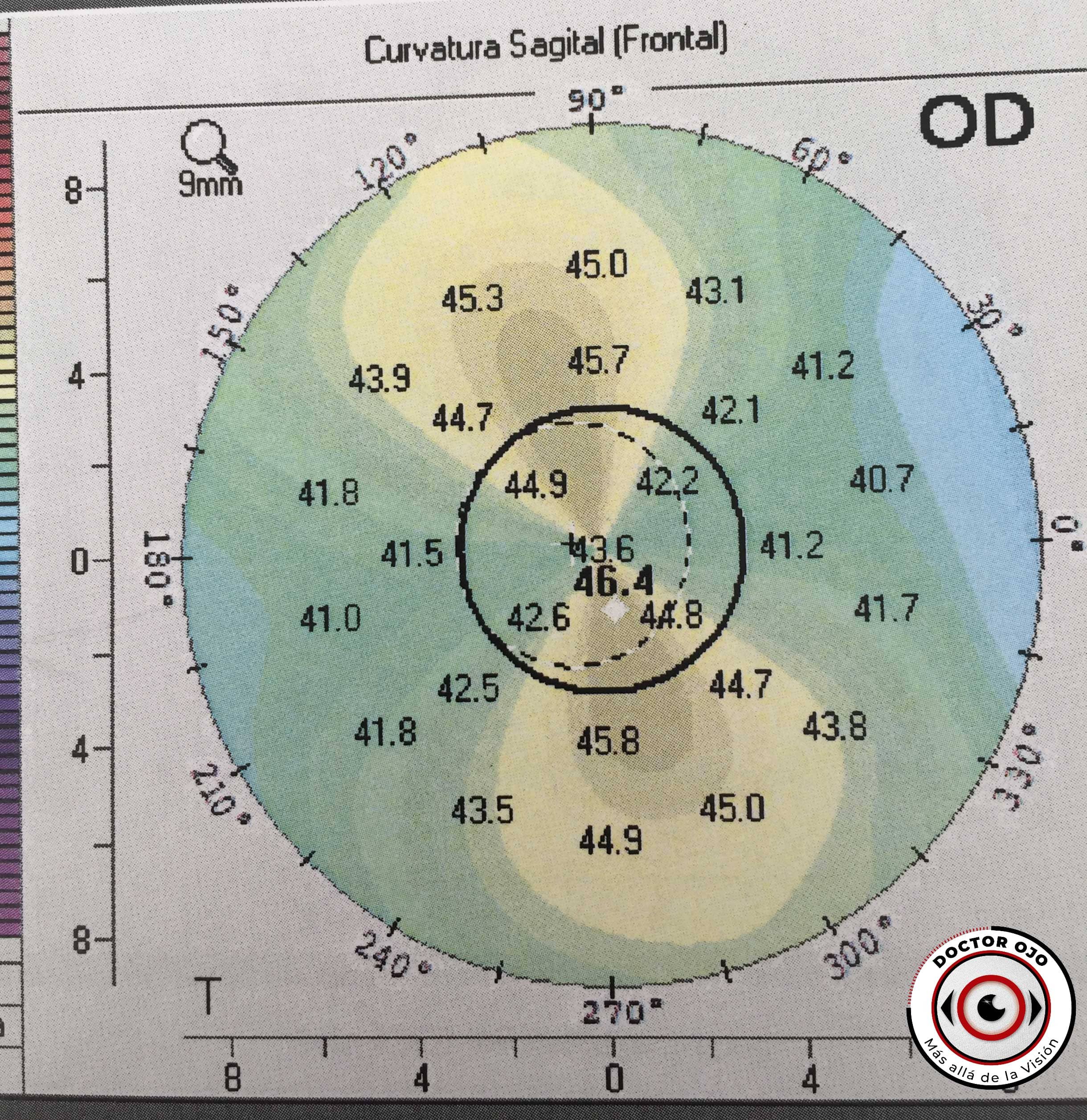 Imagen de una topografía corneal