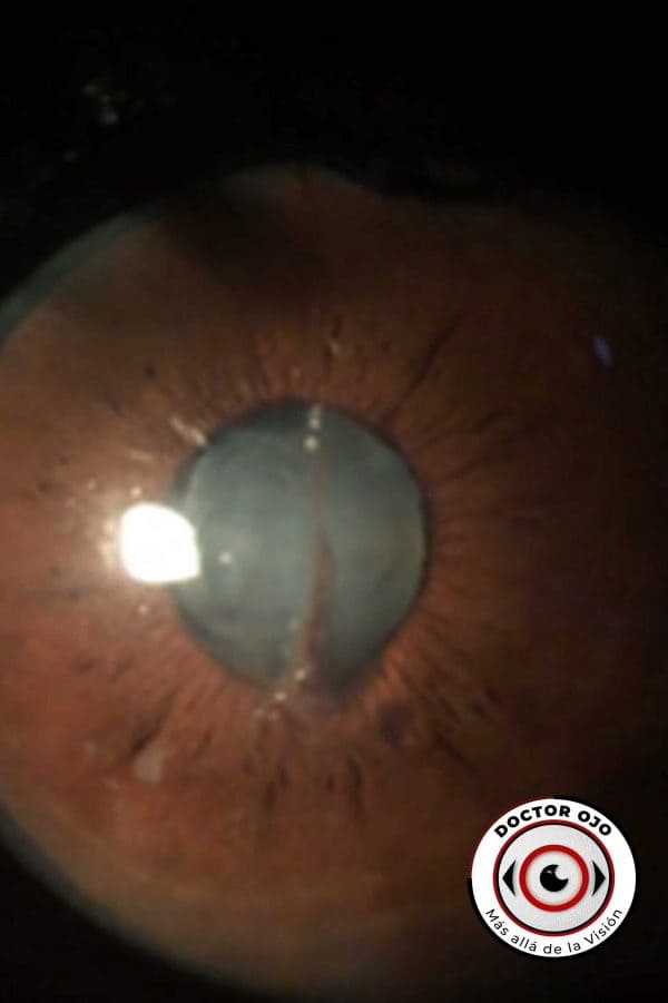 Herida corneal  traumática