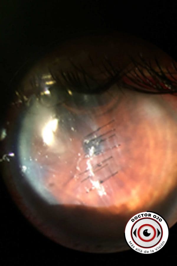 Sutura de herida corneal trauama